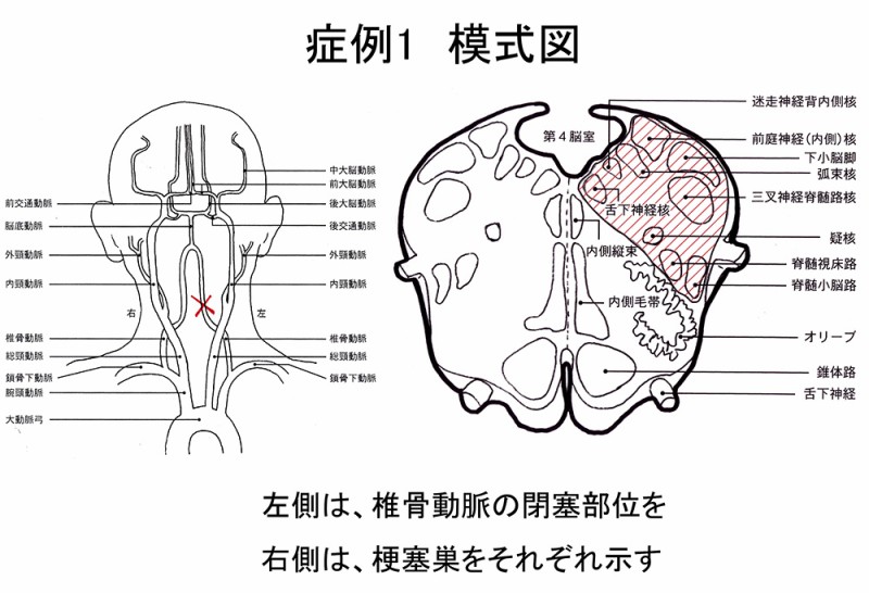 学会発表「延髄外側症候群の5症例」｜3443通信-三好耳鼻咽喉科