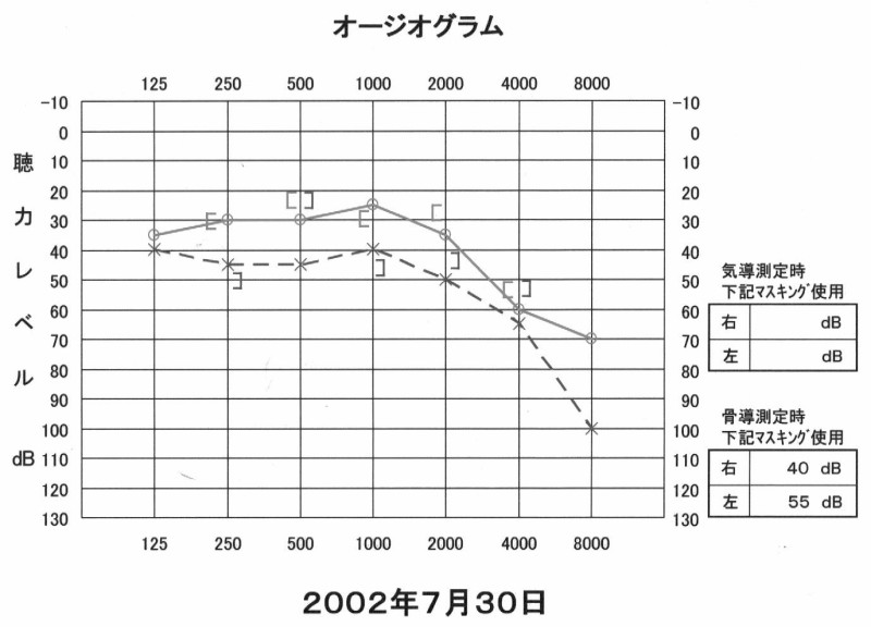 図01 初診時の聴力造
